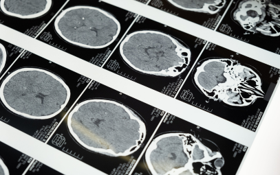 The Role of Ultrasound Guided Lumbar Puncture in the Neuroscience Intensive Care Unit: A Review and Case Presentation